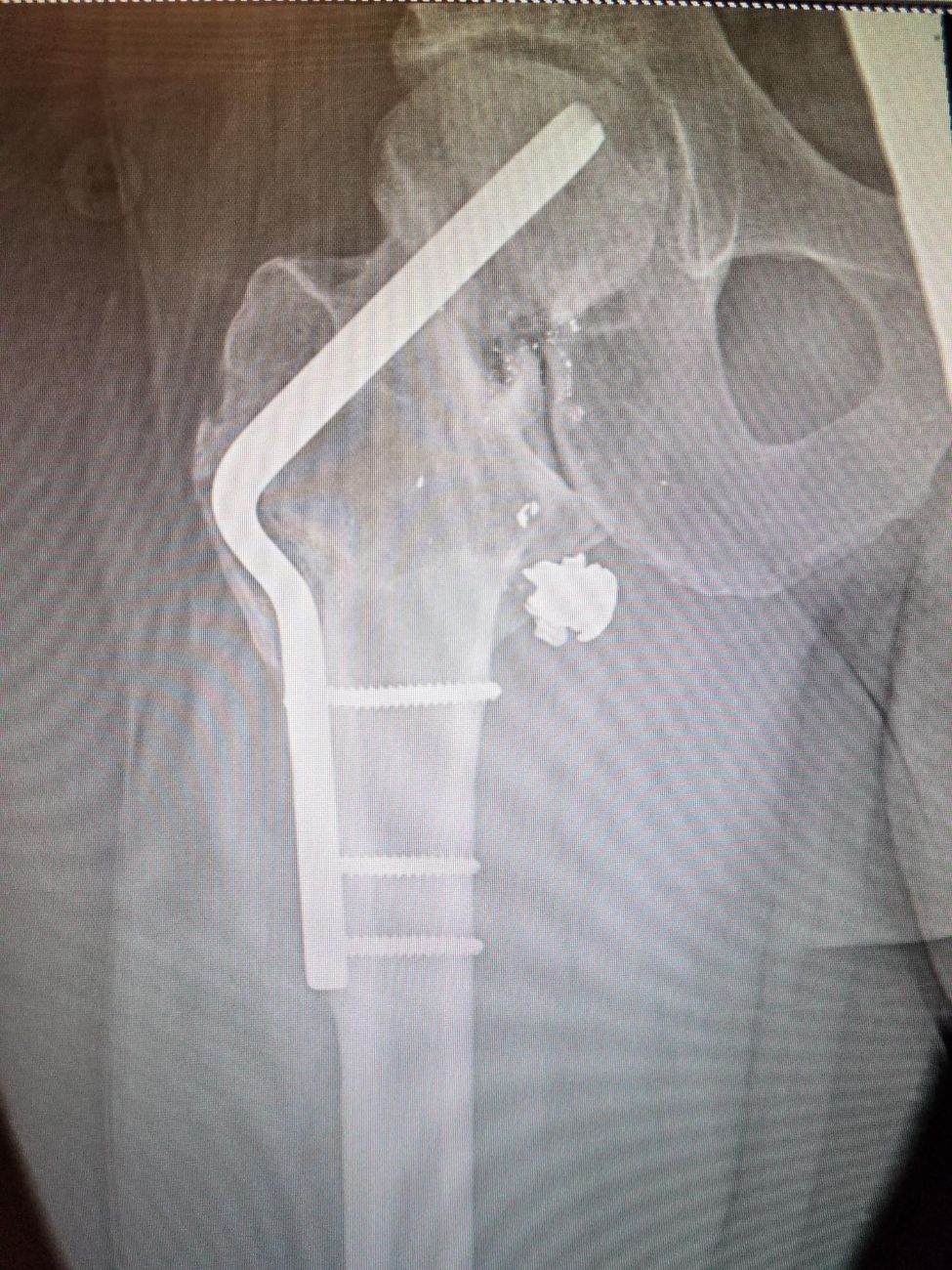 An x-ray image before Orlando Rosales' hip replacement surgery shows the location of the bullet and earlier tries to stabilize the bone.